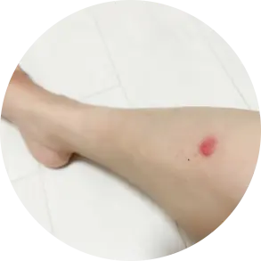 害虫被害 虫刺され1